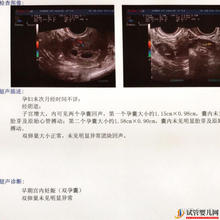 感觉很多人做试管生的都是儿子(图5) 感觉很多人做试管生的都是儿子(图5)