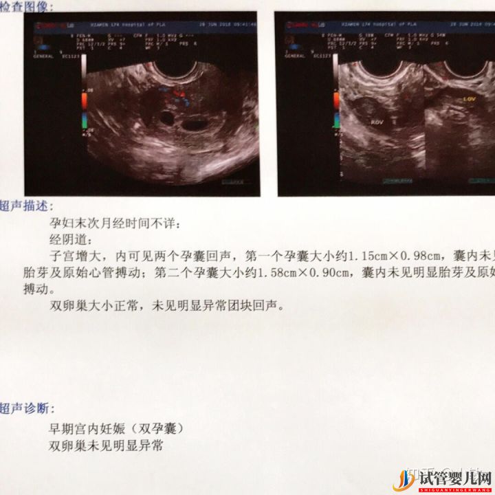 感觉很多人做试管生的都是儿子(图6) 感觉很多人做试管生的都是儿子(图6)