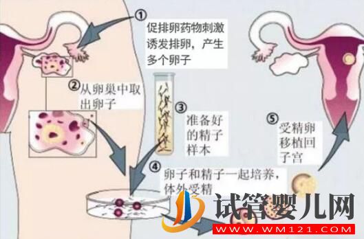 人工授精多次失败后还可以做试管婴儿吗?(图2) 人工授精多次失败后还可以做试管婴儿吗?(图2)