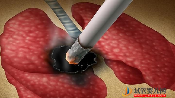 肺癌患者可以过性生活吗?你知道为什么肺癌不传染吗?-易网<a>健康养生</a>网 肺癌患者可以过性生活吗?你知道为什么肺癌不传染吗?(图2)