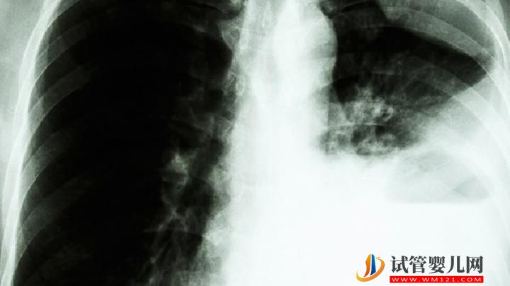 肺癌患者可以过性生活吗?你知道为什么肺癌不传染吗?-试管婴儿网 肺癌患者可以过性生活吗?你知道为什么肺癌不传染吗?(图1)