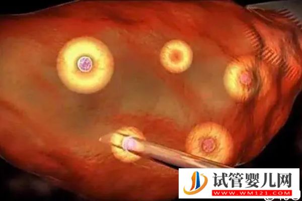 详述试管取卵后医生会不会通知家属看胚胎结果,都来瞅(图3) 详述试管取卵后医生会不会通知家属看胚胎结果,都来瞅(图3)