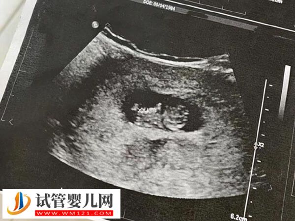 试管婴儿多久可见胎心