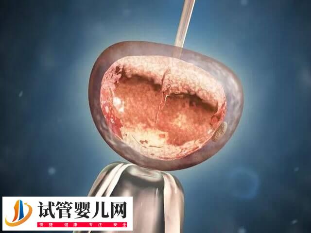 冻胚移植前要做哪些准备(图1) 冻胚移植前要做哪些准备(图1)