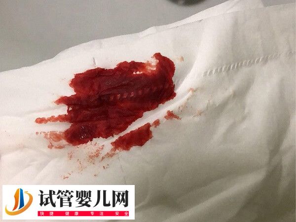 取卵后有淤血块流出正不正常(图2)