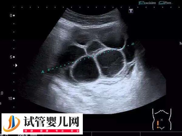 移植完胚胎后为什么腹水(图1)