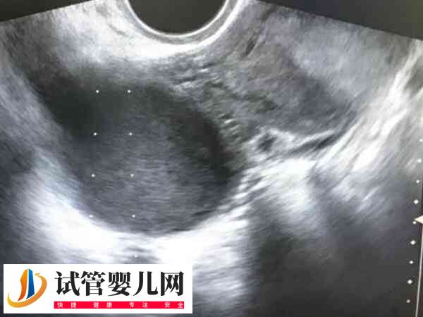 子宫腺肌症移植能否2个鲜胚怀双胎(图2)