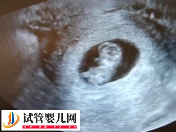 试管婴儿检查NT会不会有问题