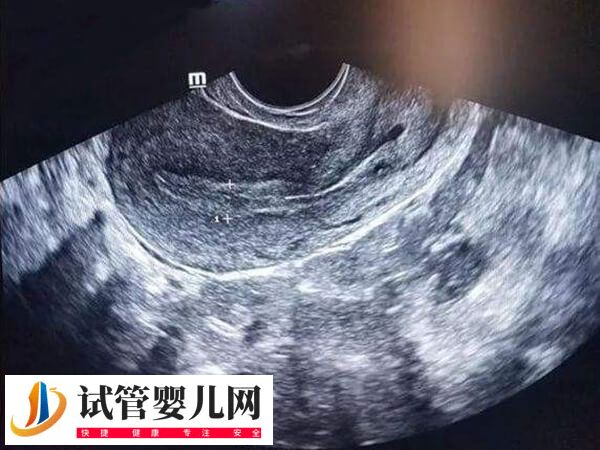 子宫切除手术有哪5种(图1) 子宫切除手术有哪5种(图1)