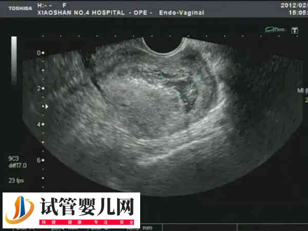 子宫切除手术危害大不大(图4) 子宫切除手术危害大不大(图4)