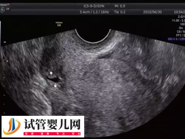 子宫憩室影不影响试管移植(图1) 子宫憩室影不影响试管移植(图1)
