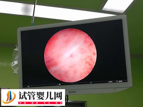 宫腔镜刮诊后多久能做试管婴儿